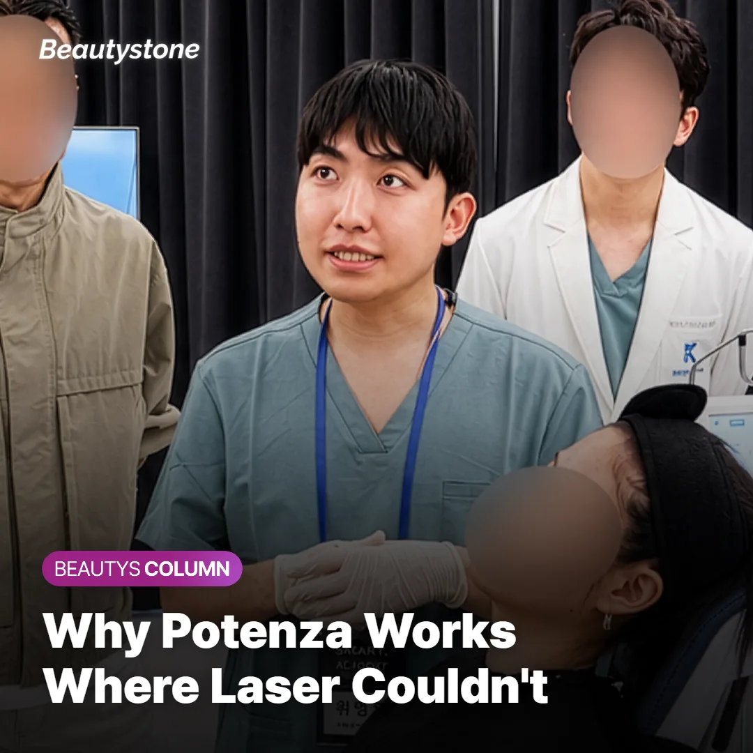 Illustration comparing Potenza RF microneedling to laser toning for enlarged pores