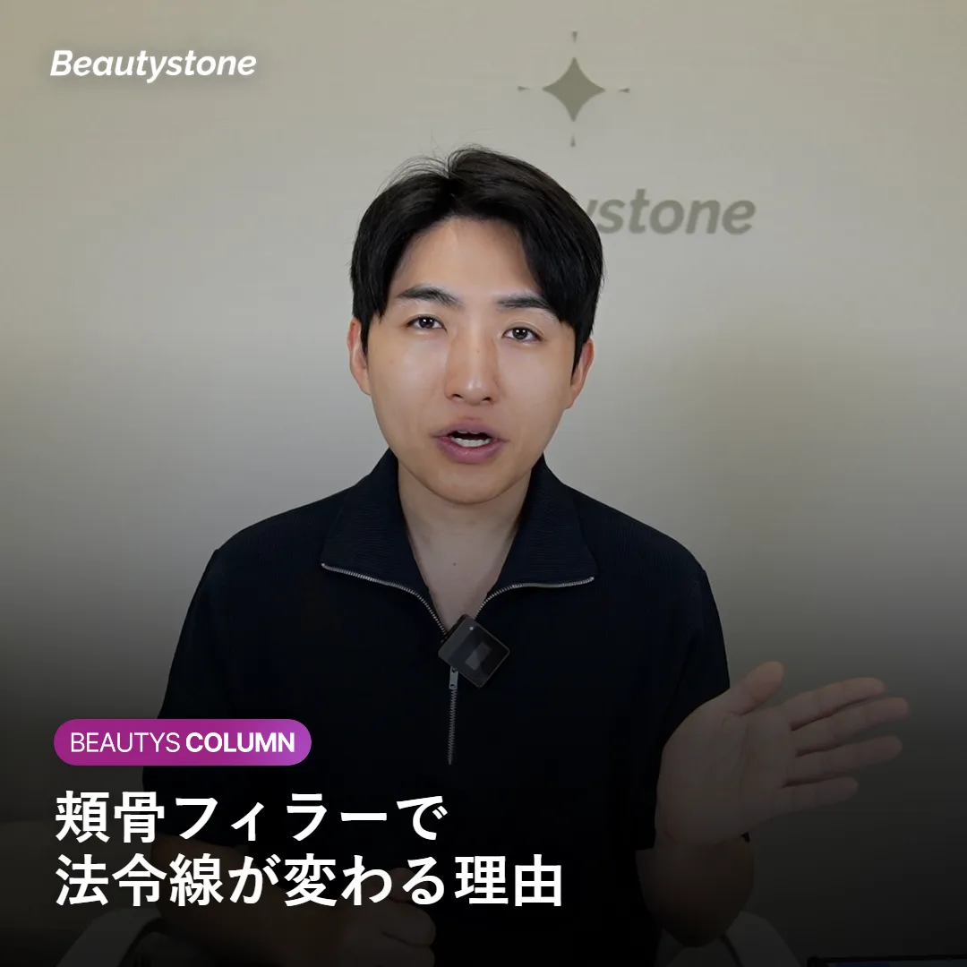 頬骨フィラーで法令線の印象が変わる様子のイメージ
