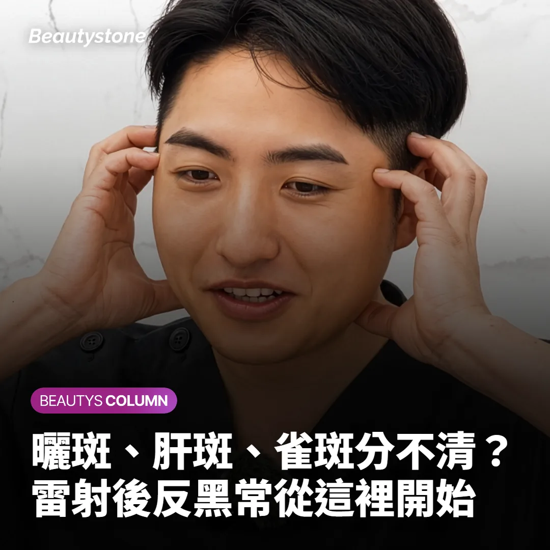 曬斑、肝斑、雀斑分不清?雷射後反黑常從這裡開始