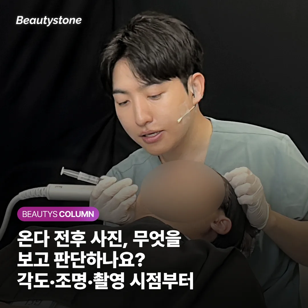 온다 전후 사진, 무엇을 보고 판단하나요? 각도·조명·촬영 시점부터 가려내는 법