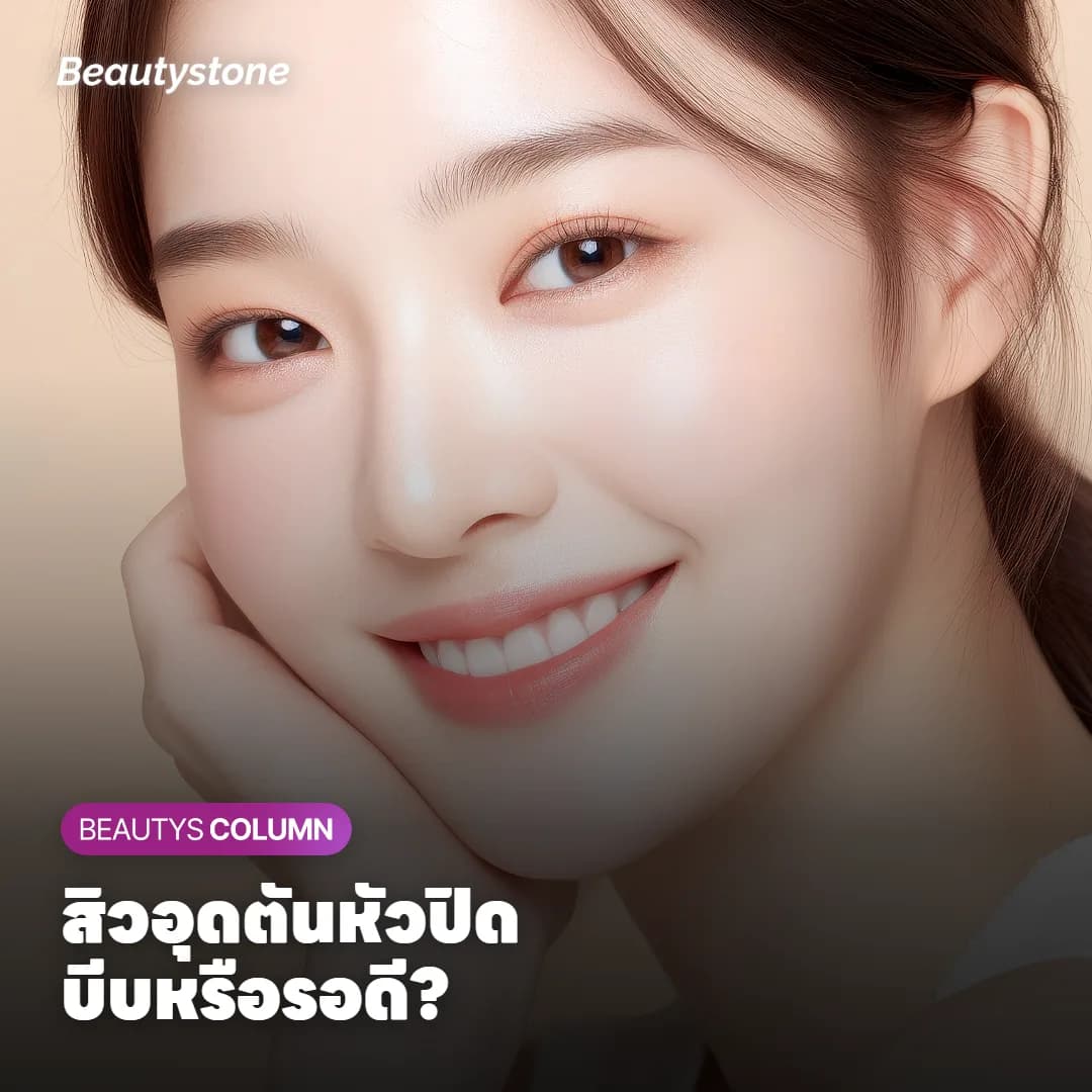 สิวอุดตันหัวปิดบีบไม่ออก ยาทาต้องใช้กี่สัปดาห์ถึงจะเห็นผล?