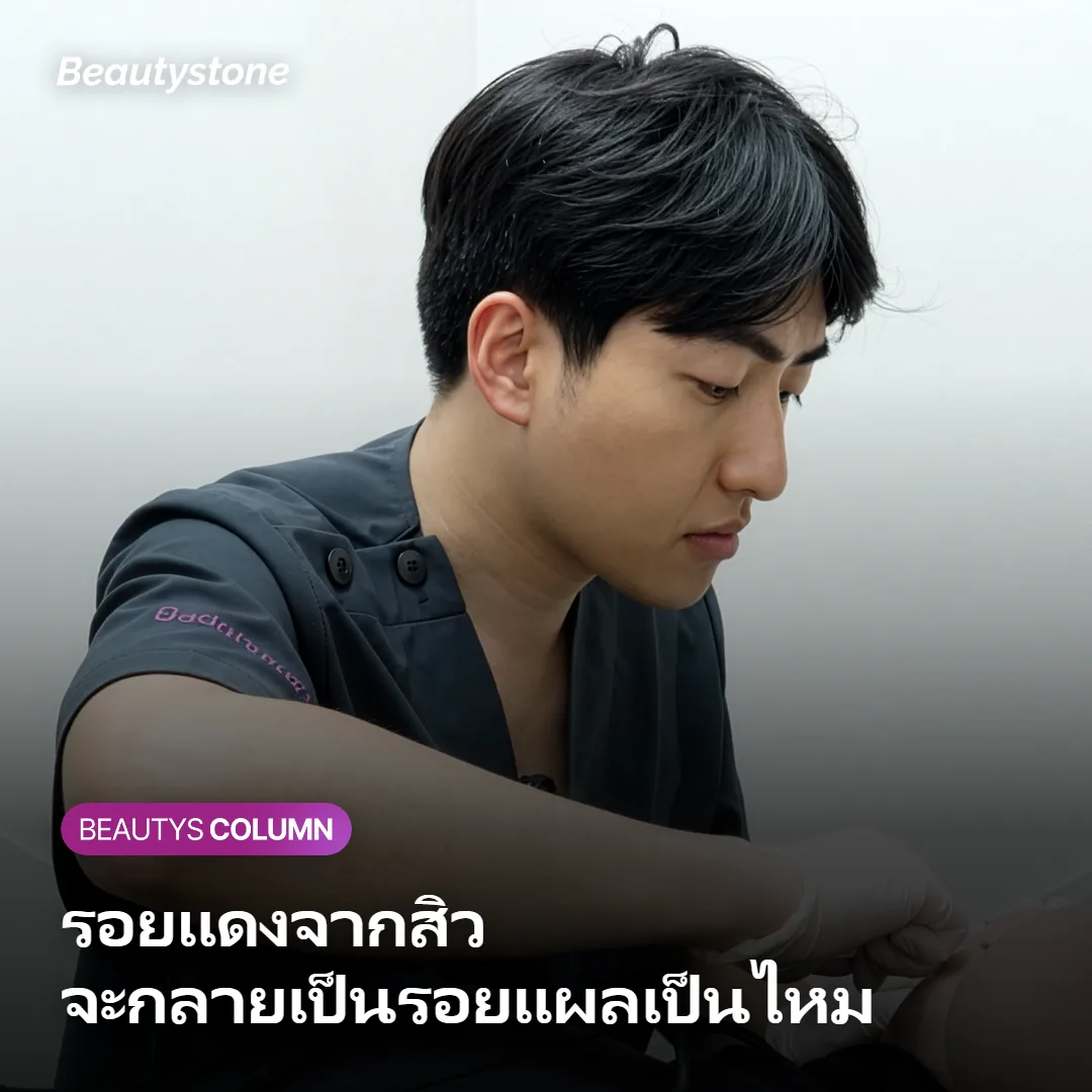 รอยแดงจากสิว จะกลายเป็นรอยแผลเป็นไหม?