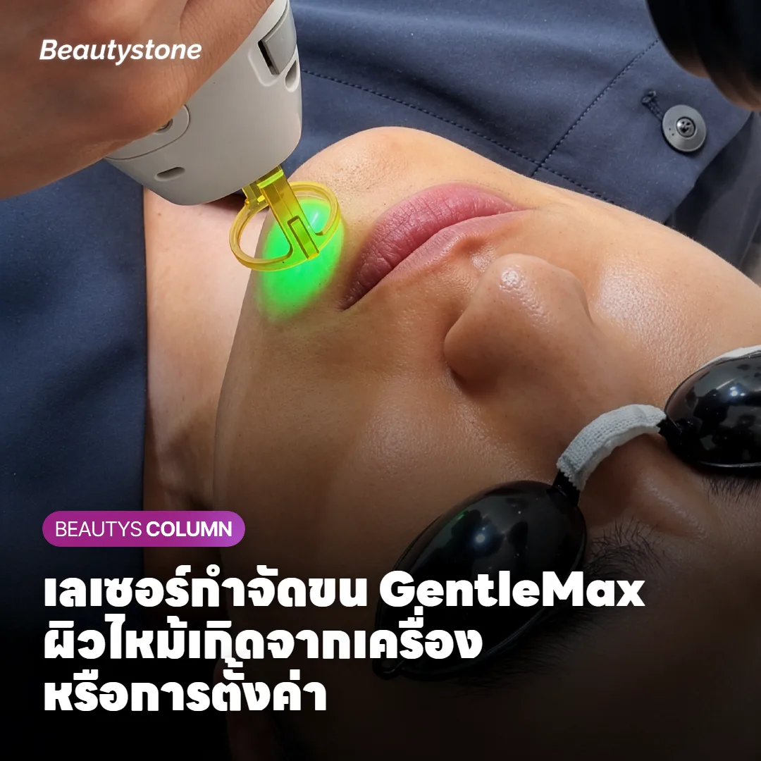 เลเซอร์กำจัดขน GentleMax ผิวไหม้เกิดจากเครื่องหรือการตั้งค่า?